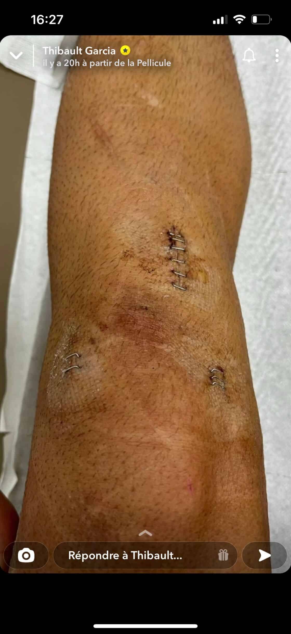 Thibault Garcia blessé : il montre son importante cicatrice au genou