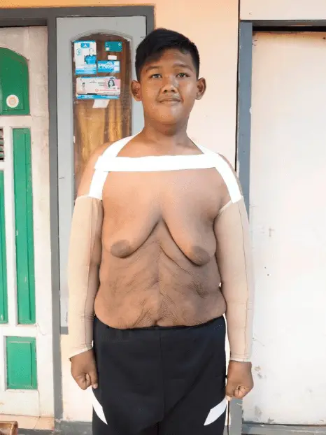 L’incroyable transformation du garçon le plus gros du monde (photos)