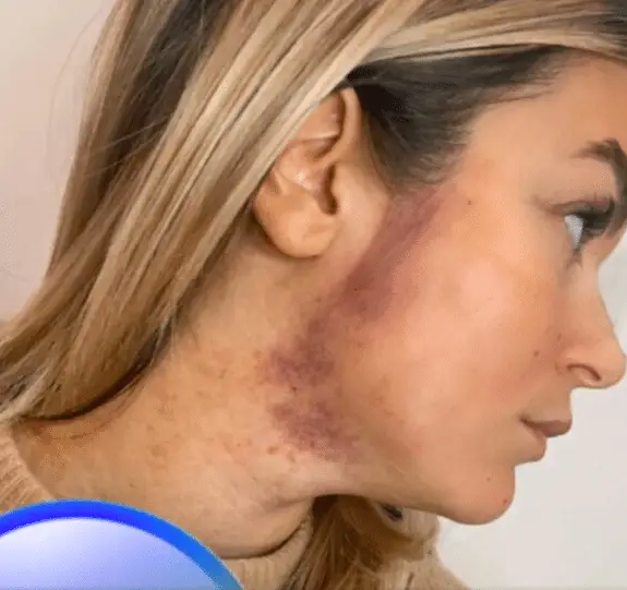 Carla Moreau : elle se montre le visage 'tuméfié' après un moment qui a mal tourné